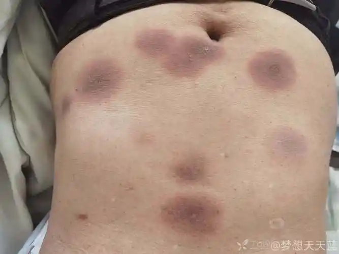 全身多处圆形红斑5年余瘙痒难忍