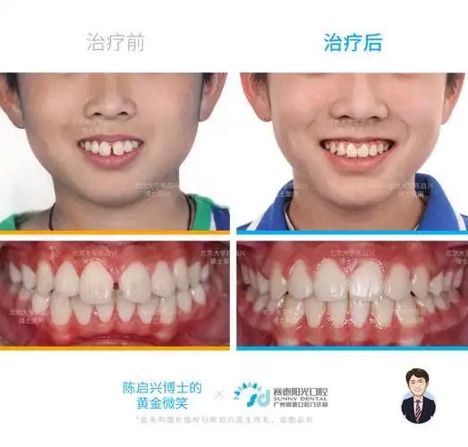 腺样体面容 嘴突 深覆盖 门牙缝过大矫正案例