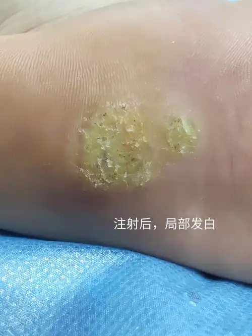 氟尿嘧啶治疗跖疣_跖疣_跖疣治疗方式 - 好大夫在线