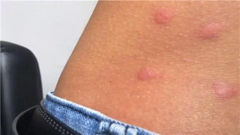 男性手部的一期梅毒图片得了一期梅毒要怎么治疗图片男的得了一期梅毒