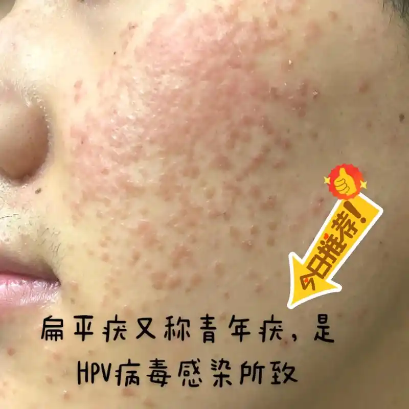 扁平疣小科普.#医学科普 #扁平疣 #hpv  - 抖音