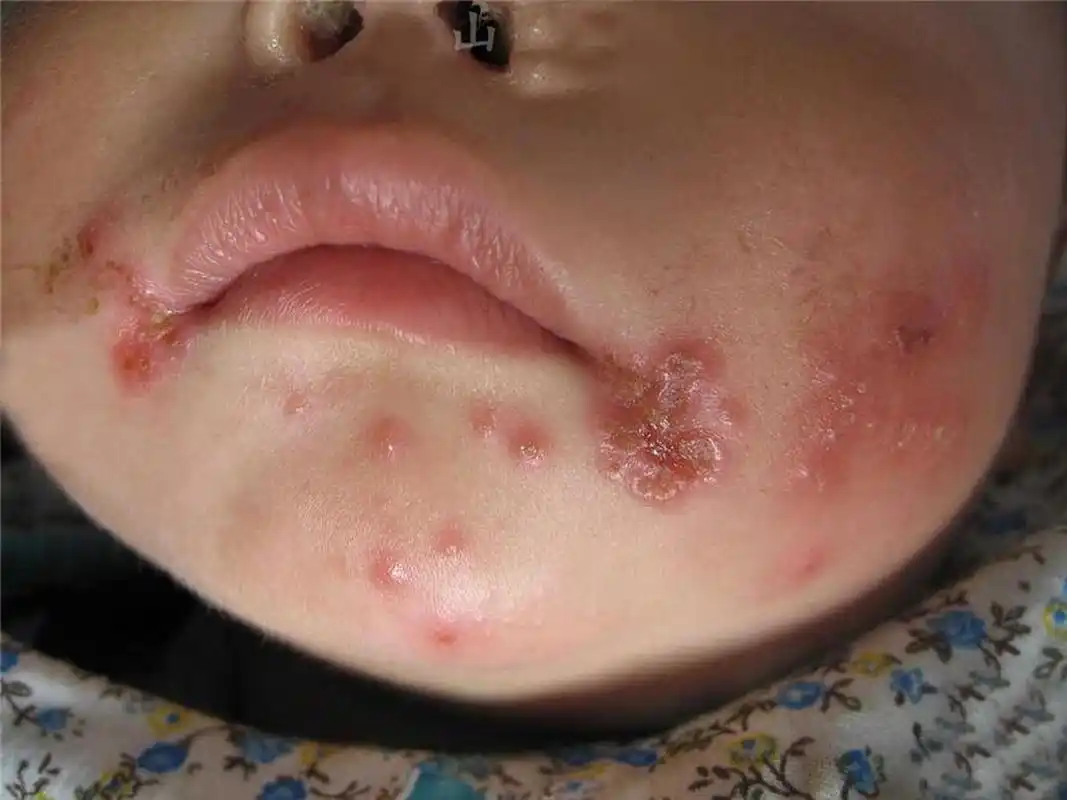 嘴巴周围长密集的小水泡反复发作很难受该怎么办?