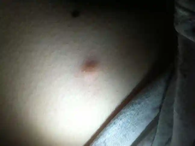 是女的26岁,怀2胎的时候胸部下2寸长了一个红疙瘩,我平时很