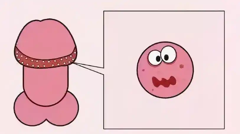 龟头上有小红点,一般考虑是包皮龟头炎