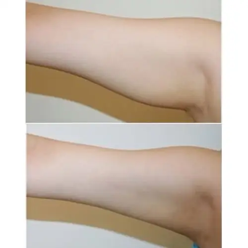 [:163]体验前变美诉求:因为手臂粗的原因,这么_圈子-新氧美容整形