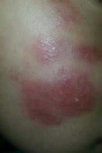 小孩子发烧之后脸上突然起疱疹一样的东西 怎么回事