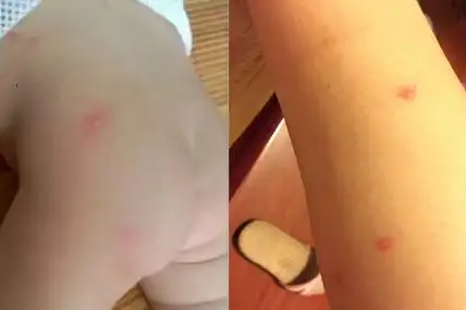 【图】螨虫过敏症状图片 几个病因你要了解