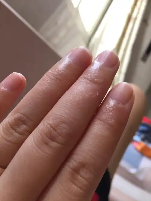 回事就会起水泡,典型的症状是在手指的侧面手掌或脚掌先有刺痒的感觉