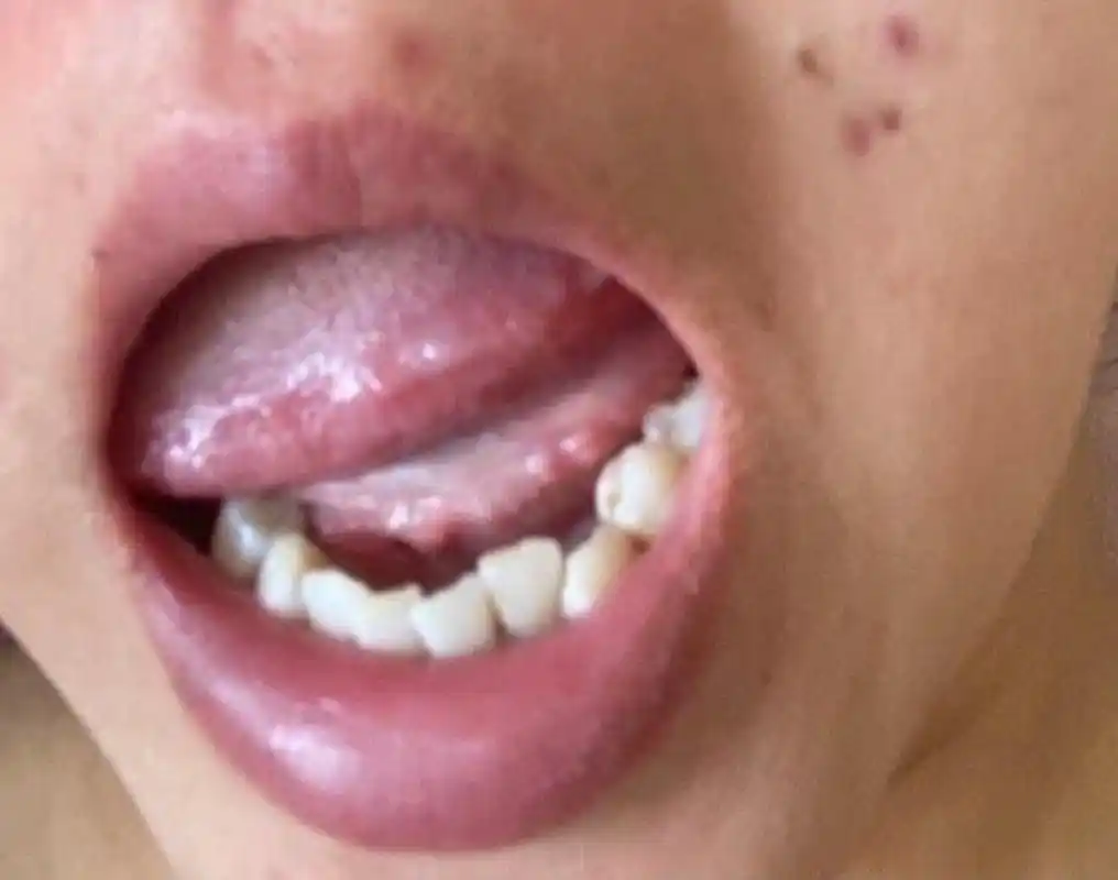 健康美好生活计划# 你好医生,我怀疑口腔感染hpv?