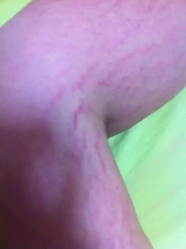 腿上有肥胖纹了怎么办!