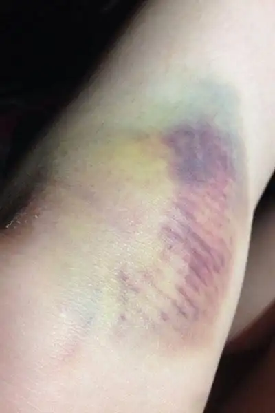 很多时候看到女生膝盖的淤青,大家都会感到莫名的尴尬,认为是因为一些