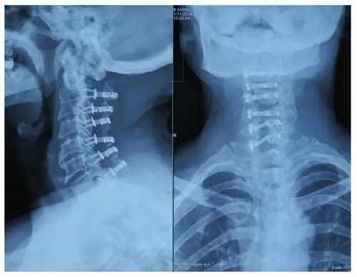 第一次术后,颈椎x线(颈2-7节段)