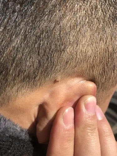 耳后长个小肉粒,怎么回事?