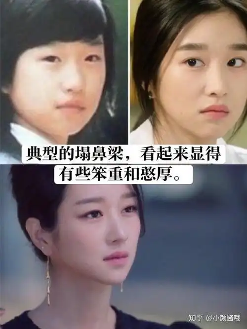 韩国最热门的鼻子整形模板徐睿知的鼻子