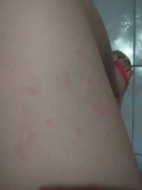 一到夏天,就长这种红疹,但是不痒,请问怎么回事,怎么治疗