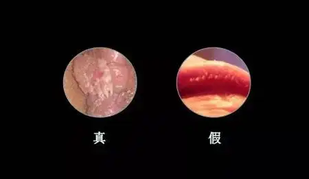 真假尖锐湿疣辨别方法真假尖锐疣图片
