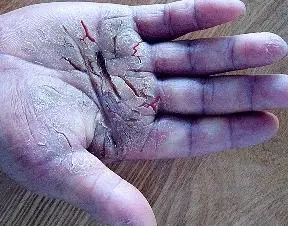 干燥的冬天来了想远离皮肤皲裂的痛苦你可能需要做这些