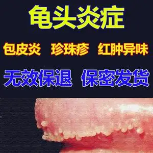 治疗男性龟头炎喷剂霉菌性包皮消炎膏珍珠疹白垢红点阴茎痒瘙药膏