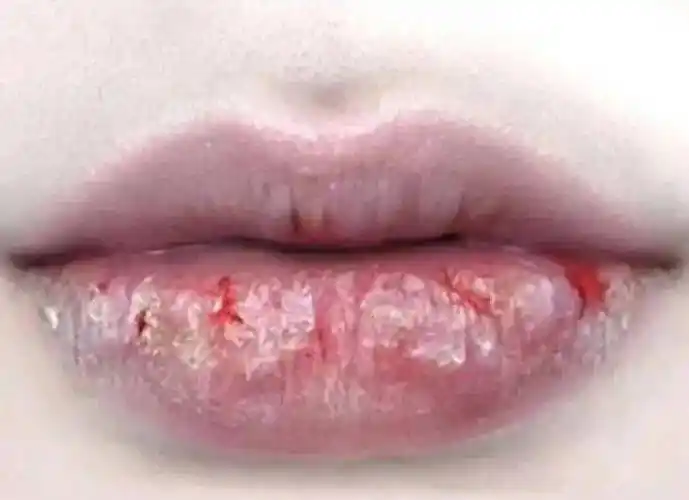 秋冬用错唇膏=烂嘴!起皮,干燥,让嘴又丑又疼,每天抹点它就好了