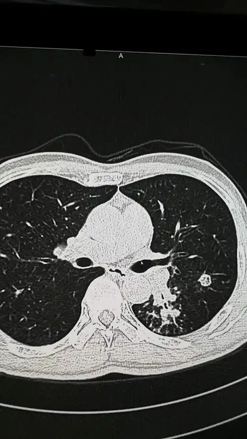伴有粘液栓的肺结核 - 美篇