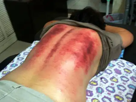 两条线之间有一个大包,这种情况类似于气血足,出痧很多,经络堵的很