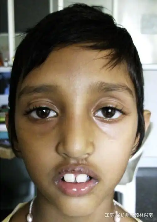 孩子口呼吸危害有多大?凸嘴,打鼾,腺样体面容. - 知乎