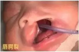 唇腭裂宝宝护理.