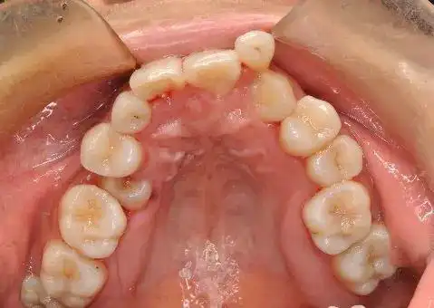 牙齿不齐会遗传给下一代吗?