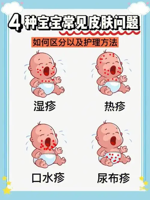 一篇搞定73宝宝湿疹红屁屁热疹口水疹