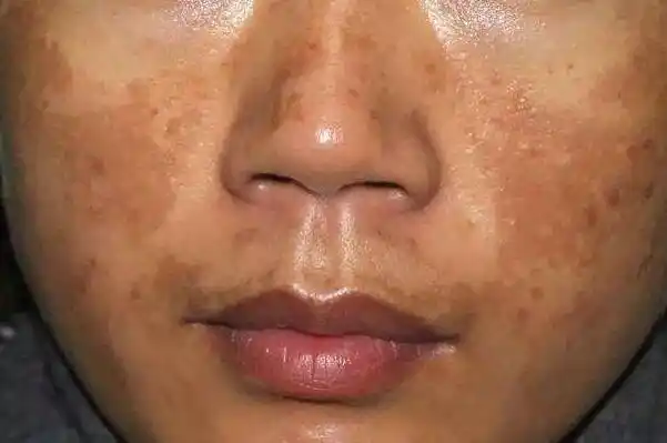 黄褐斑为什么治不好?什么方法去黄褐斑快?