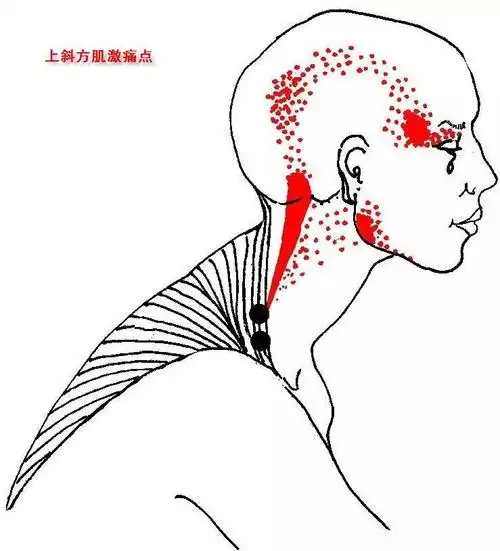 中斜方肌纤维通常不产生激痛点,但如果有疼痛点存在,在肩胛骨内缘靠近