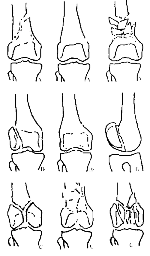 分类 高等教育 医学 逆行交锁髓内钉内固定治疗股骨髁上及髁间骨折43