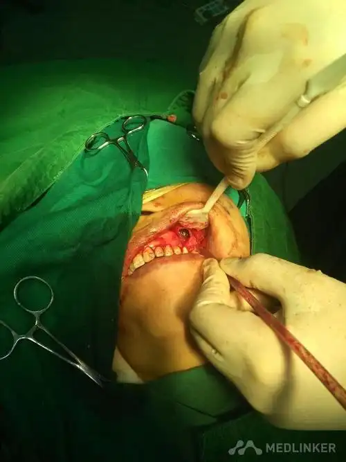 左上颌骨囊肿感染合伴上颌窦炎一例-医联