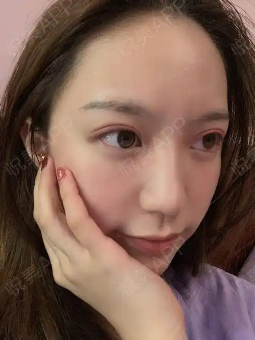 眼综合整形术后7天_全切双眼皮术后7天_眼型矫正术后7天_眼综合术后7