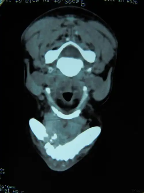 下颌骨右侧已发生骨吸收