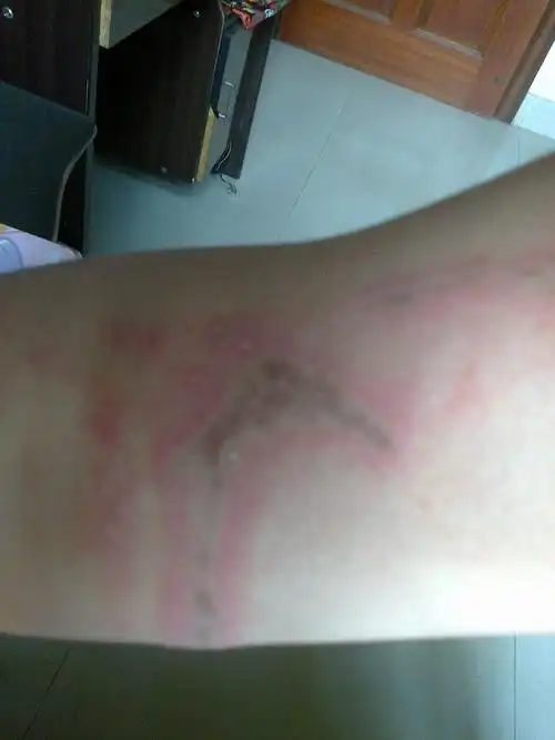 右手臂上出现了环形的红疹中间有褐色沉淀而且还会痛