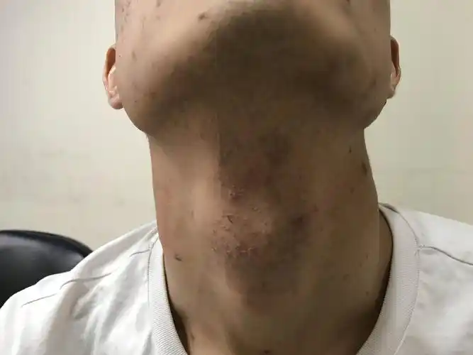 多发性扁平疣治愈示范病例 - 好大夫在线