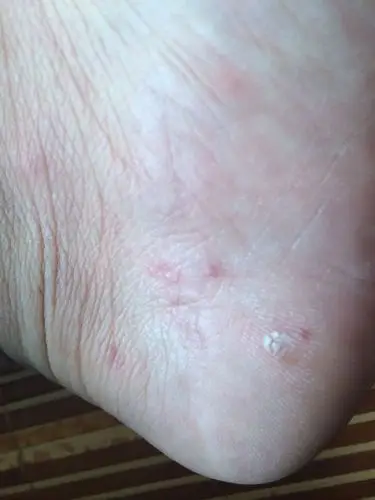 脚上长了这种红点点,有点痒,要涂什么药膏才能止痒消退啊