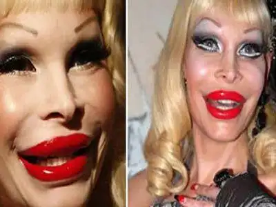 恐怖!世界12大最可怕的整形失败案例