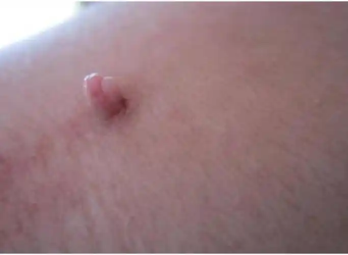 假尖锐湿疣状撞馐酝计琠有来医生