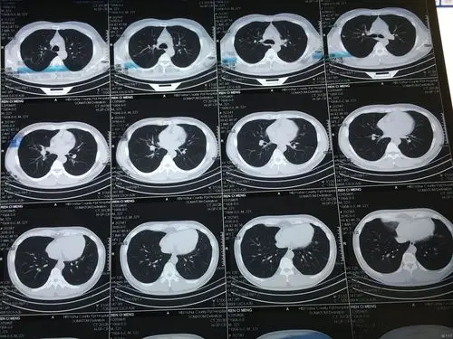 这个胸部ct是活动性结核吗