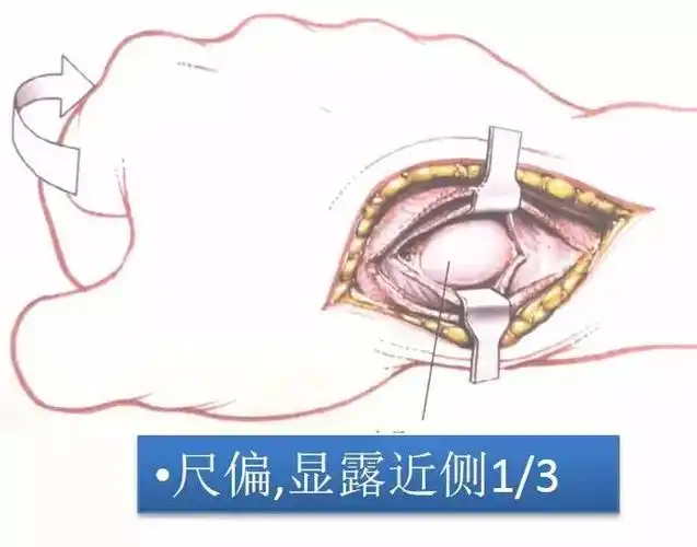 专题教程舟状骨骨折的7种手术入路详解