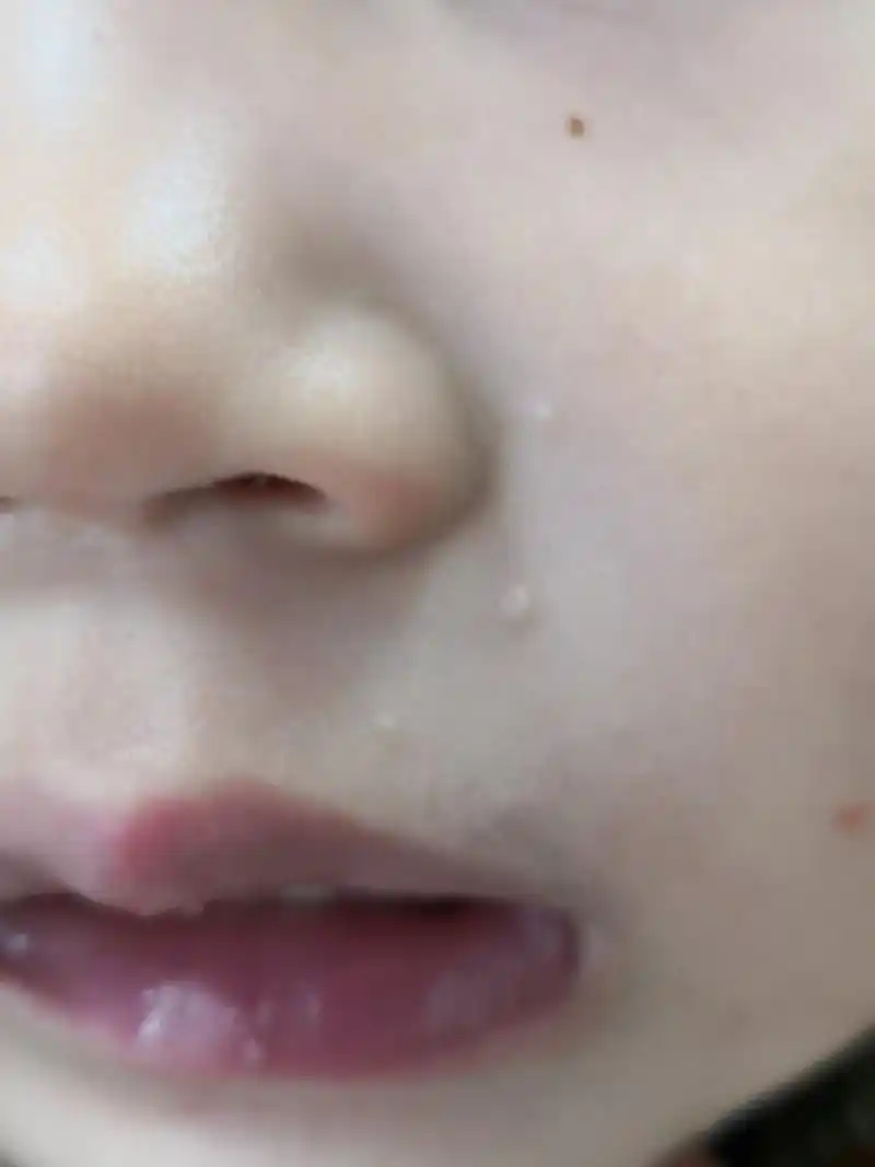 儿童面部躯干部位的传染性软疣症状#传染性软疣# 可以使用药物治疗