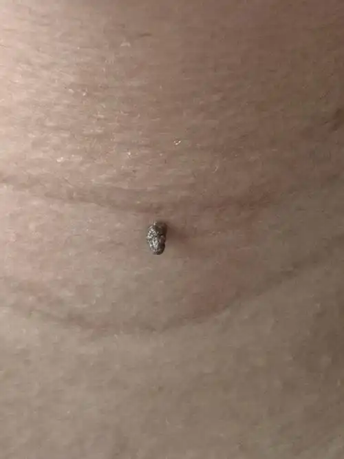 皮赘和丝状疣傻傻分不清##解决皮肤问题专注皮肤美容##皮赘