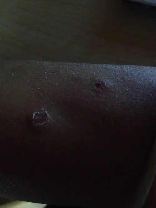 被跳蚤,虱子咬了是这样的吗