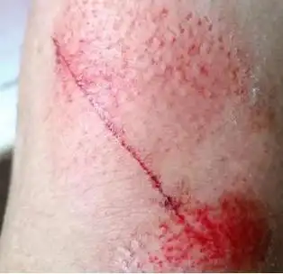 摔伤的腿.图片由受访者提供