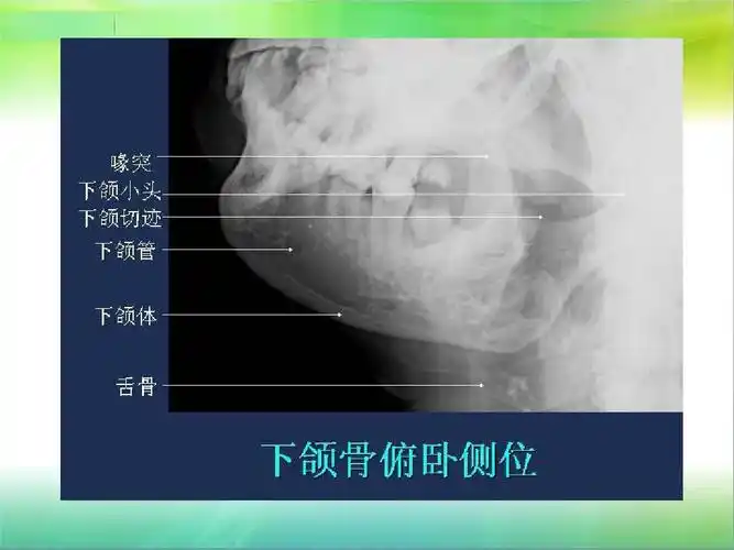 头颅五官投照及x线解剖ppt