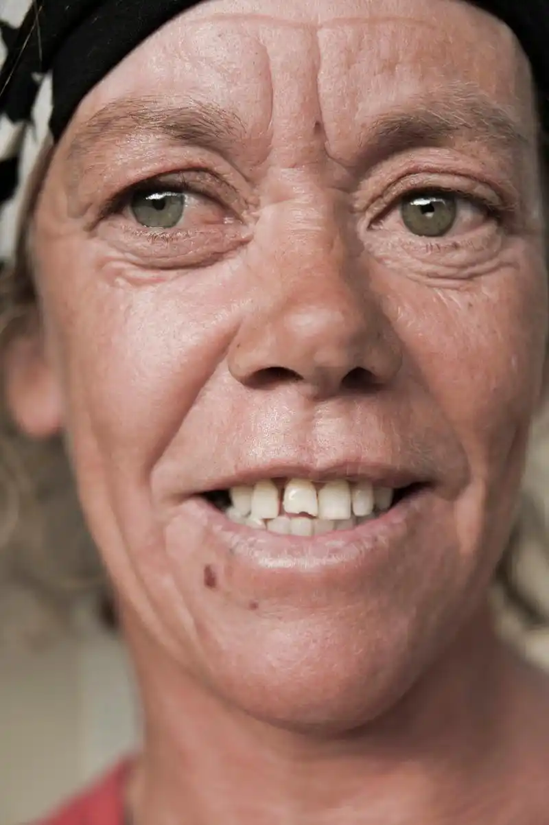 医美#   "印第安纹"通常是指法令纹或嘴角皱纹.