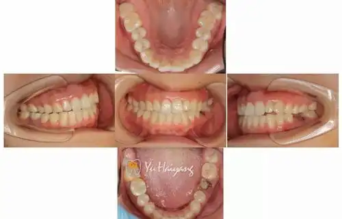 华西口腔于海洋教授-绚彩 3d pro 病例分享一种植一体化氧化锆冠修复