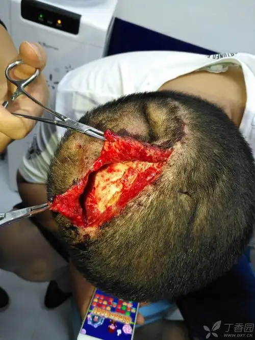 头部脂肪瘤术后感染切口裂开